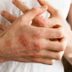 10 Types of Poison Ivy Treatment You’ll Be Thankful to Know