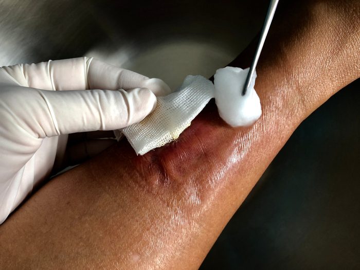 cellulitis or wound on skin
