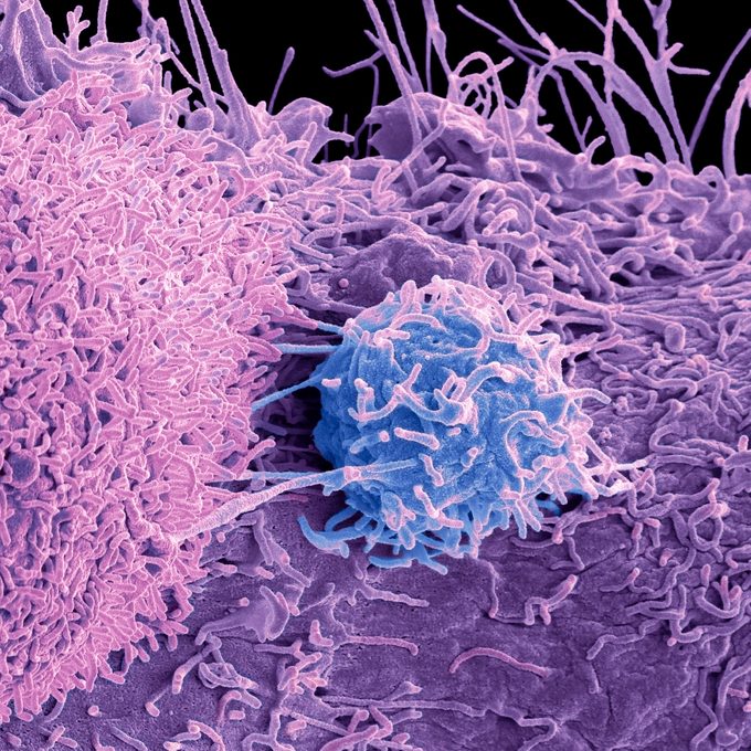 Prostate Cancer cells