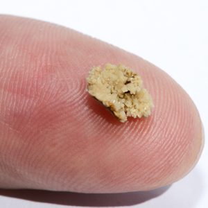 8mm Human Kidney Stone On A Finger